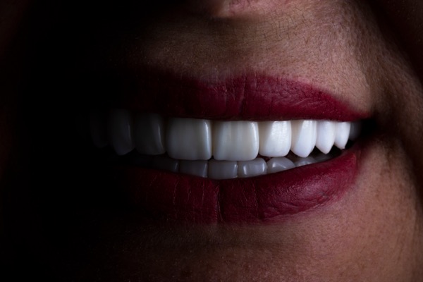 Lentes de contato dental em Recife — Odonto Spazzio