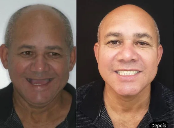 Seu Carlos, 58 anos — paciente da Odonto Spazzio em Recife